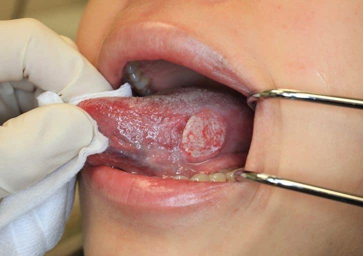 What Is Tongue Cancer?